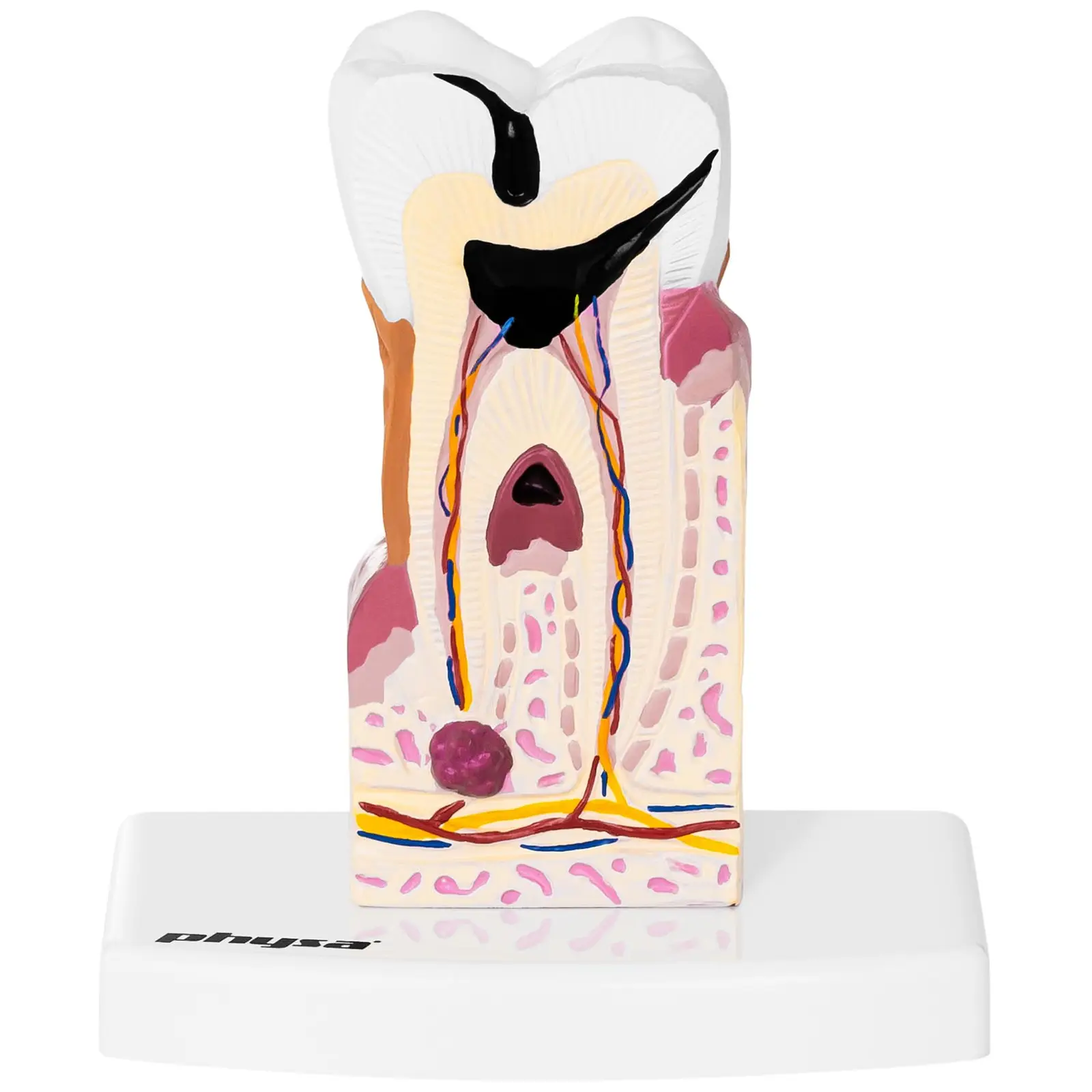 Maquette anatomique de la dentition humaine - Molaire malade